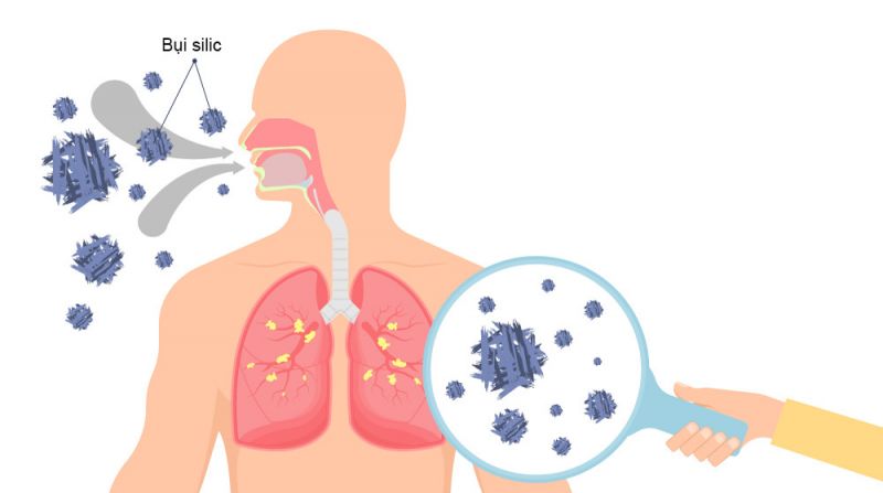Bệnh bụi phổi Silic nghề nghiệp, nguy&ecirc;n nh&acirc;n v&agrave; c&aacute;ch ph&ograve;ng ngừa