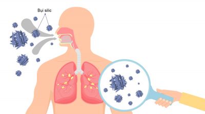 Bệnh bụi phổi Silic nghề nghiệp, nguy&ecirc;n nh&acirc;n v&agrave; c&aacute;ch ph&ograve;ng ngừa